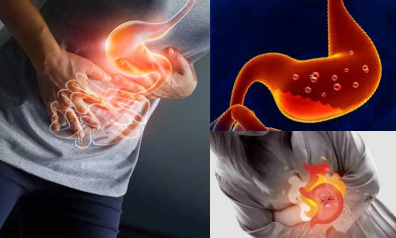 Gastrit Nedir? Belirtileri ve Tedavisi Nasıl Olmalıdır?